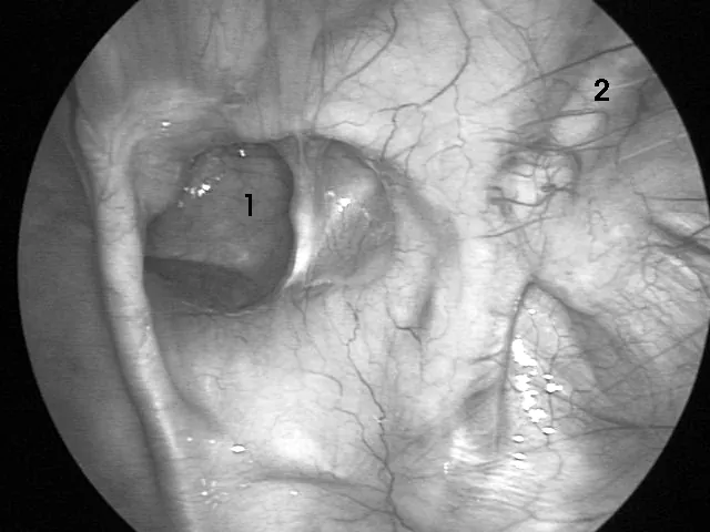 Hernia inguinal directa vista por laparoscopía